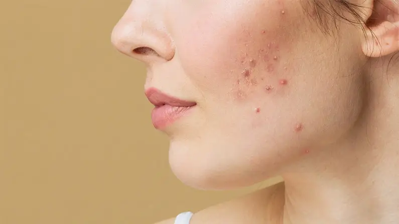 10 Things You Probably Didn’t Know About Acne