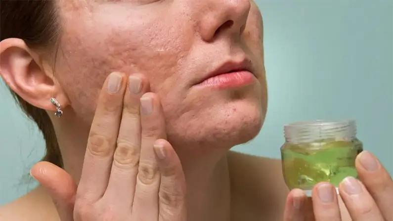 10 Things You Probably Didn’t Know About Acne