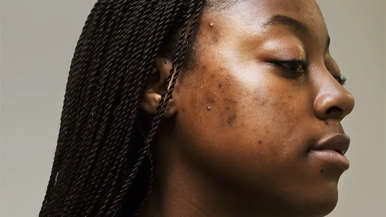 10 Things You Probably Didn’t Know About Acne