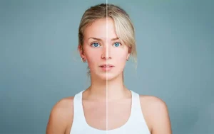 10 Things You Probably Didn’t Know About Acne